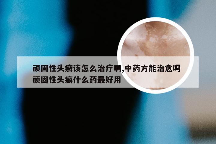 顽固性头癣该怎么治疗啊,中药方能治愈吗 顽固性头癣什么药最好用