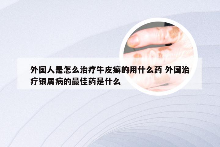 外国人是怎么治疗牛皮癣的用什么药 外国治疗银屑病的最佳药是什么