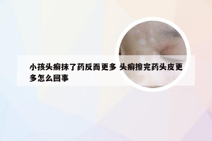 小孩头癣抹了药反而更多 头癣擦完药头皮更多怎么回事