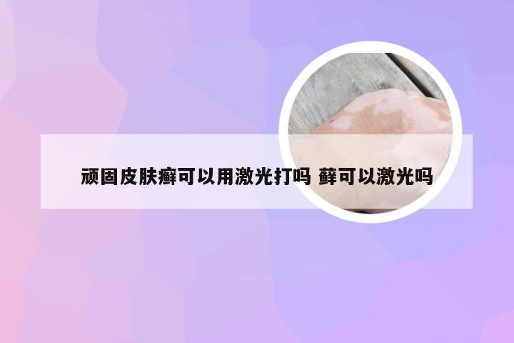 顽固皮肤癣可以用激光打吗 藓可以激光吗