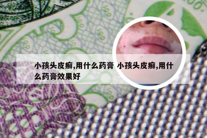 小孩头皮癣,用什么药膏 小孩头皮癣,用什么药膏效果好