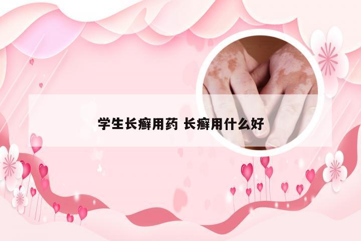 学生长癣用药 长癣用什么好