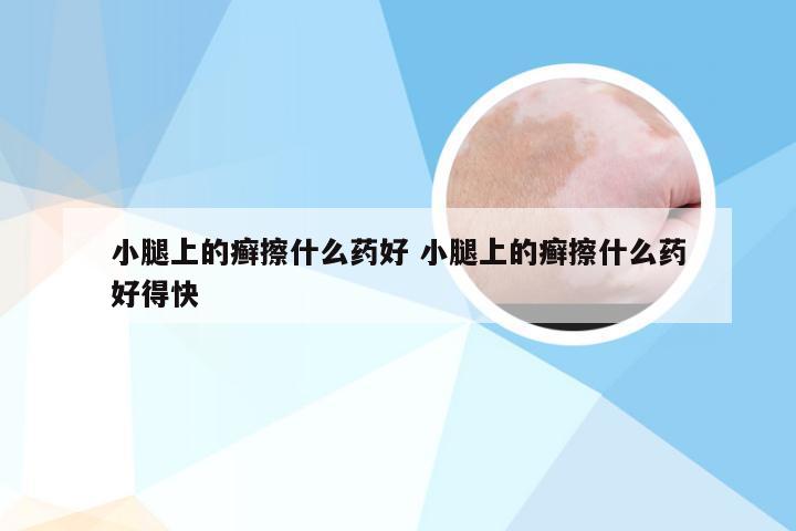 小腿上的癣擦什么药好 小腿上的癣擦什么药好得快