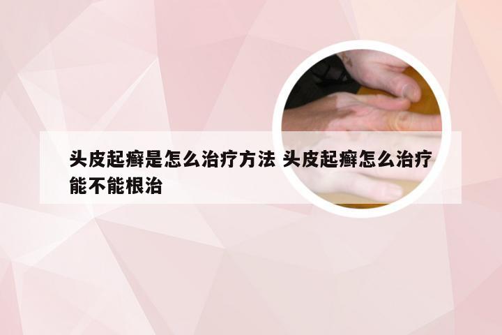 头皮起癣是怎么治疗方法 头皮起癣怎么治疗能不能根治