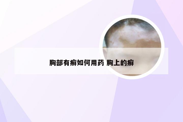 胸部有癣如何用药 胸上的癣