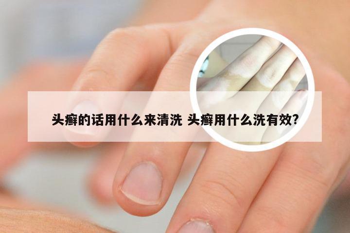 头癣的话用什么来清洗 头癣用什么洗有效?