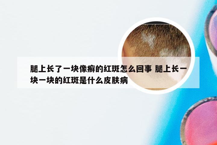 腿上长了一块像癣的红斑怎么回事 腿上长一块一块的红斑是什么皮肤病