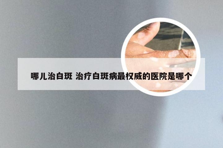 哪儿治白斑 治疗白斑病最权威的医院是哪个