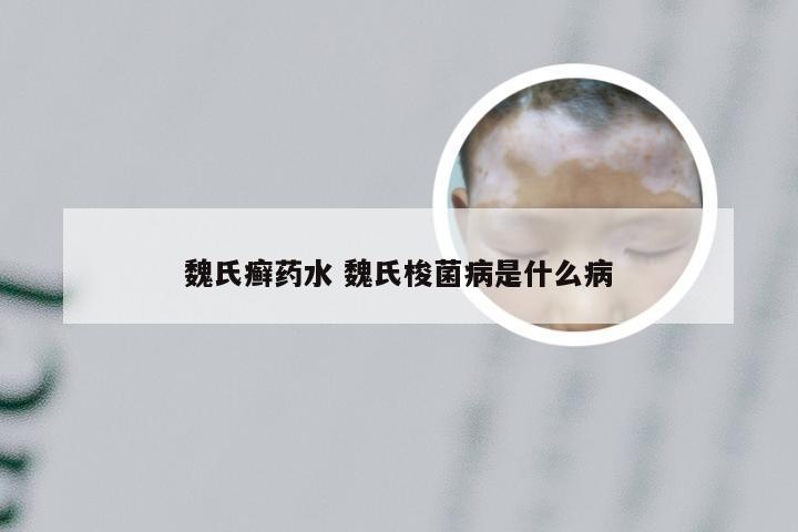 魏氏癣药水 魏氏梭菌病是什么病