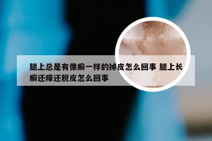 腿上总是有像癣一样的掉皮怎么回事 腿上长癣还痒还脱皮怎么回事