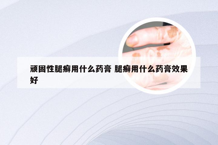 顽固性腿癣用什么药膏 腿癣用什么药膏效果好