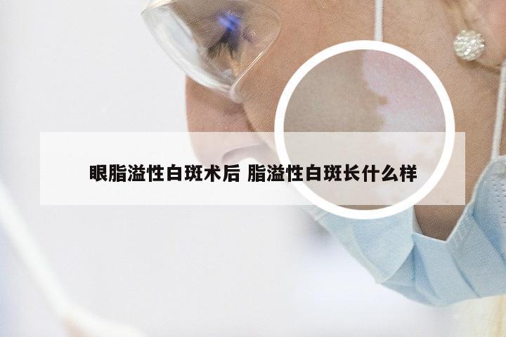 眼脂溢性白斑术后 脂溢性白斑长什么样