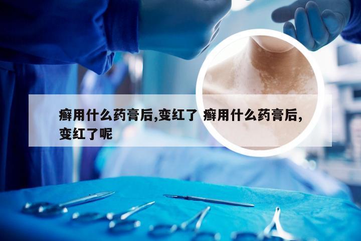 癣用什么药膏后,变红了 癣用什么药膏后,变红了呢