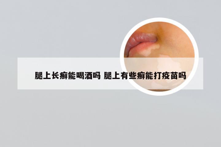 腿上长癣能喝酒吗 腿上有些癣能打疫苗吗