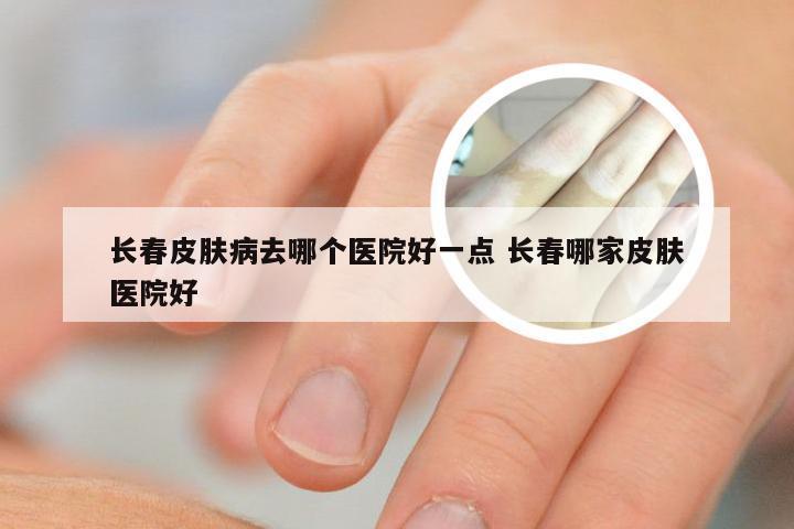 长春皮肤病去哪个医院好一点 长春哪家皮肤医院好