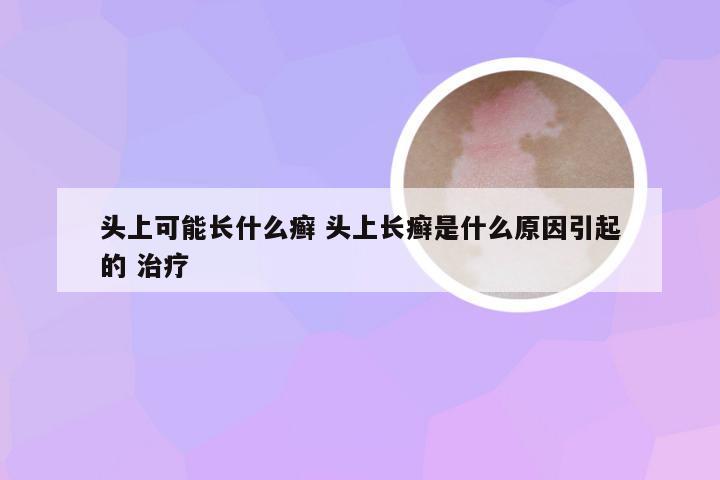 头上可能长什么癣 头上长癣是什么原因引起的 治疗