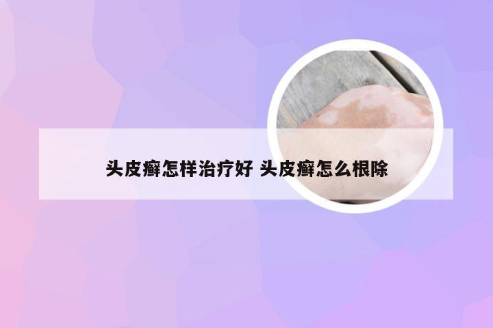 头皮癣怎样治疗好 头皮癣怎么根除