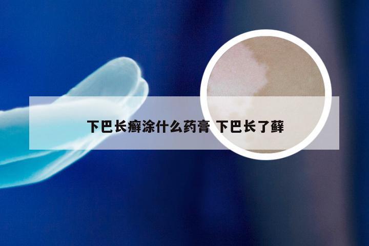 下巴长癣涂什么药膏 下巴长了藓