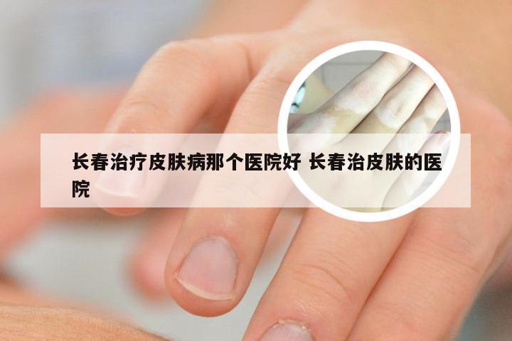 长春治疗皮肤病那个医院好 长春治皮肤的医院