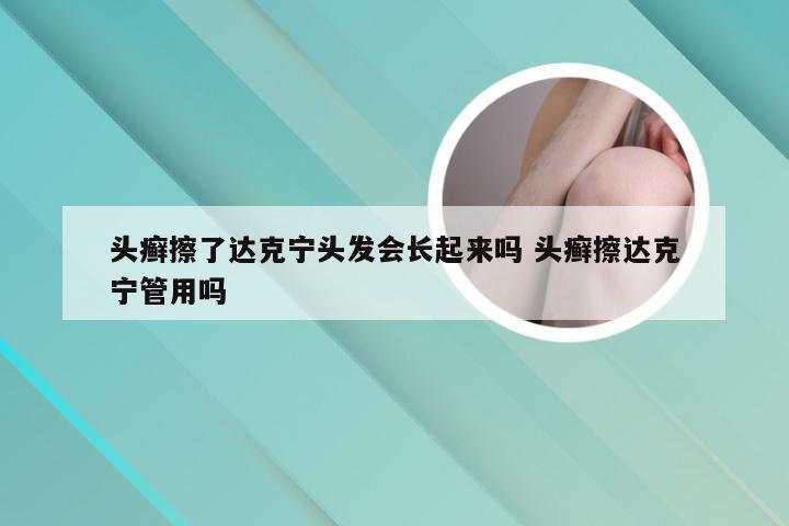 头癣擦了达克宁头发会长起来吗 头癣擦达克宁管用吗