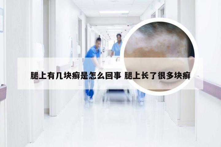 腿上有几块癣是怎么回事 腿上长了很多块癣