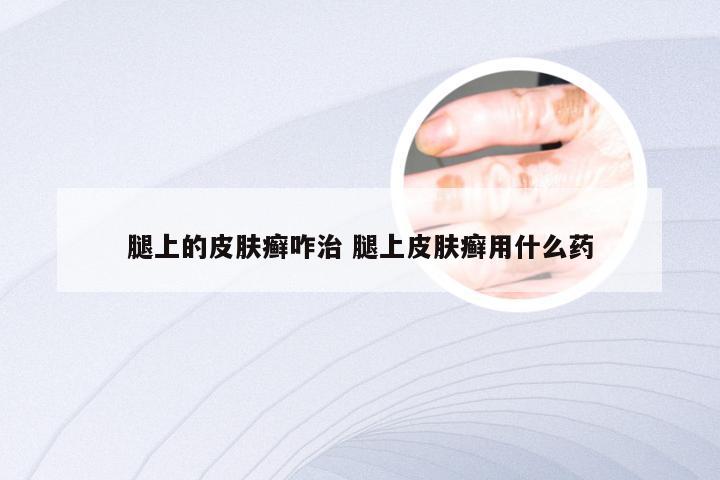 腿上的皮肤癣咋治 腿上皮肤癣用什么药