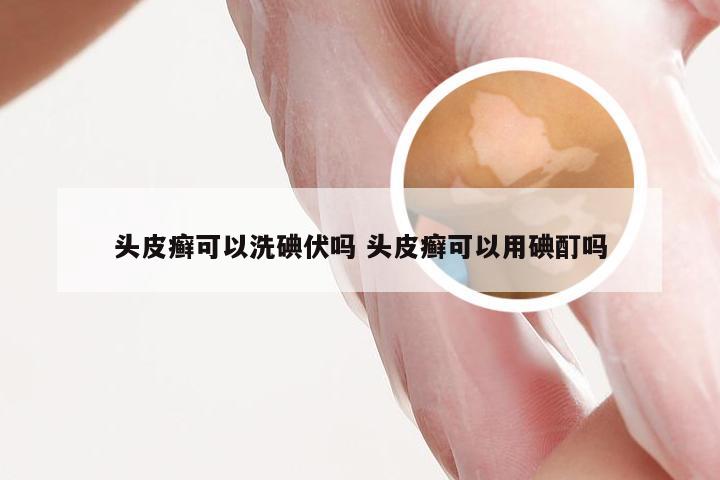 头皮癣可以洗碘伏吗 头皮癣可以用碘酊吗