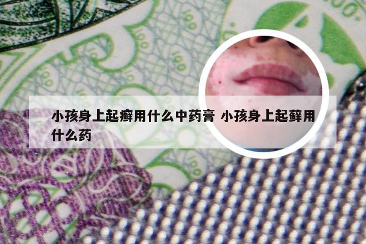 小孩身上起癣用什么中药膏 小孩身上起藓用什么药