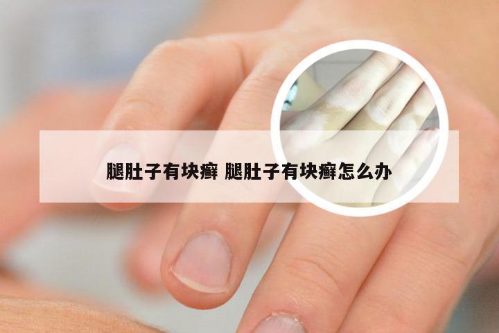 腿肚子有块癣 腿肚子有块癣怎么办