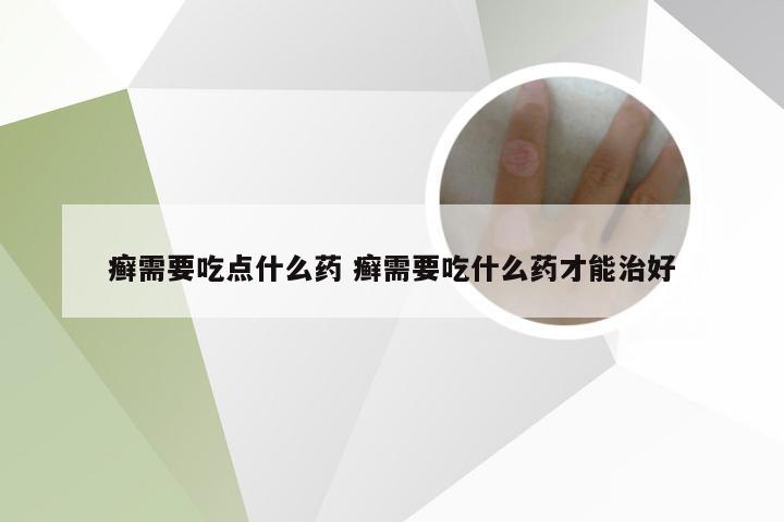 癣需要吃点什么药 癣需要吃什么药才能治好