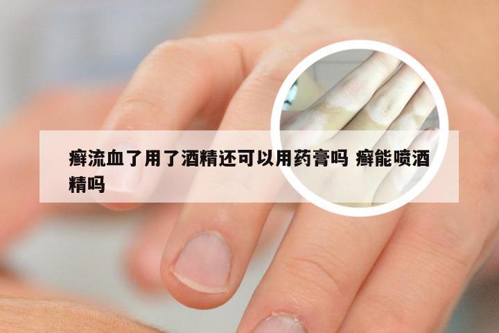 癣流血了用了酒精还可以用药膏吗 癣能喷酒精吗