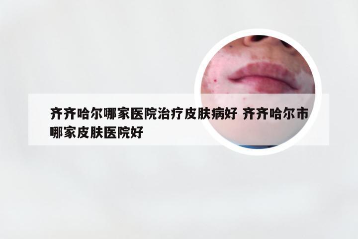 齐齐哈尔哪家医院治疗皮肤病好 齐齐哈尔市哪家皮肤医院好