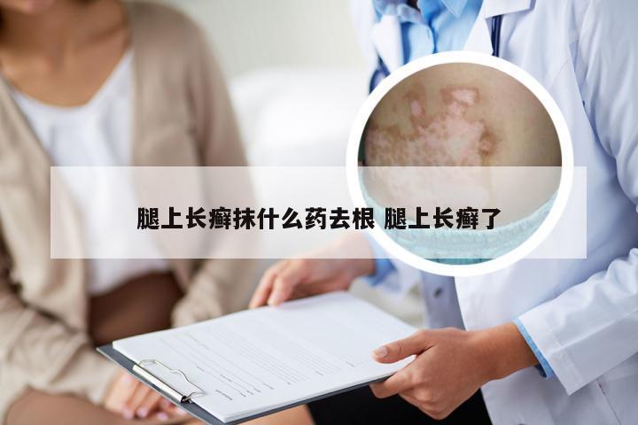 腿上长癣抹什么药去根 腿上长癣了