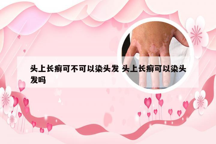 头上长癣可不可以染头发 头上长癣可以染头发吗