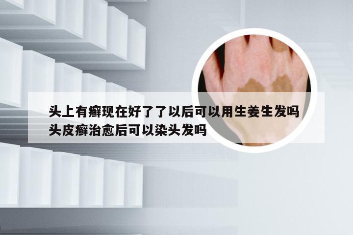 头上有癣现在好了了以后可以用生姜生发吗 头皮癣治愈后可以染头发吗