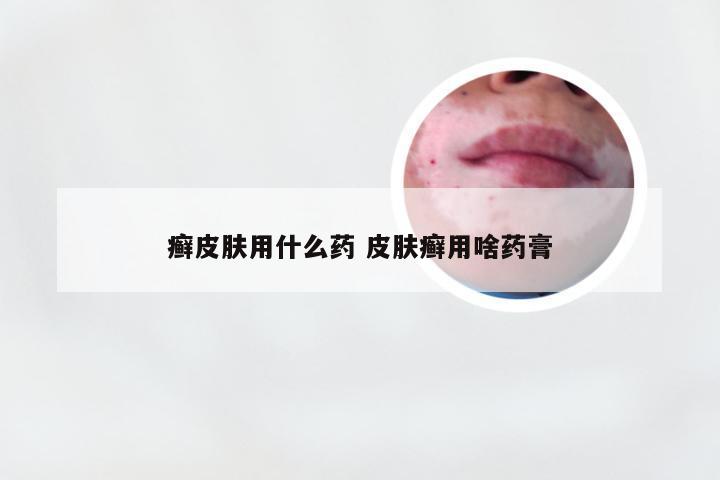 癣皮肤用什么药 皮肤癣用啥药膏