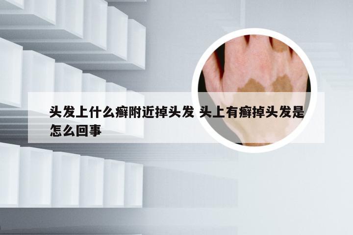 头发上什么癣附近掉头发 头上有癣掉头发是怎么回事