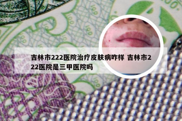 吉林市222医院治疗皮肤病咋样 吉林市222医院是三甲医院吗