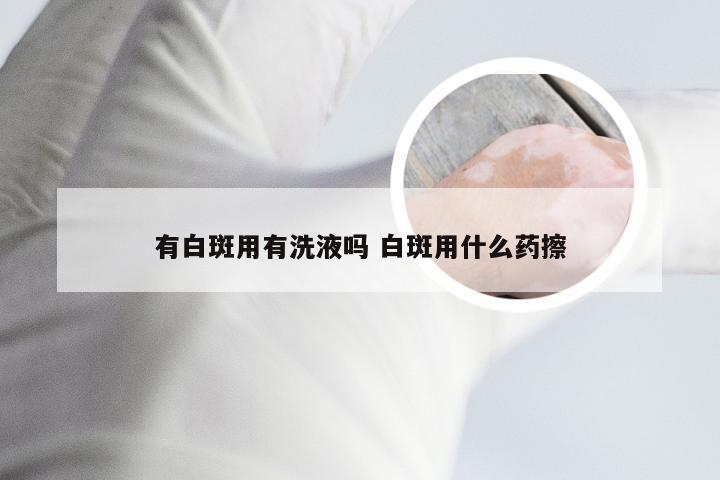 有白斑用有洗液吗 白斑用什么药擦