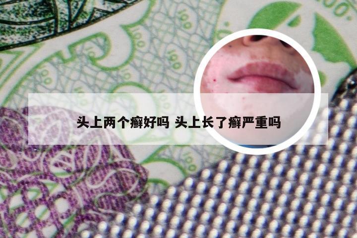 头上两个癣好吗 头上长了癣严重吗