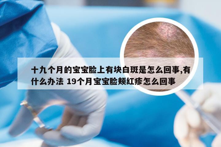 十九个月的宝宝脸上有块白斑是怎么回事,有什么办法 19个月宝宝脸颊红疹怎么回事