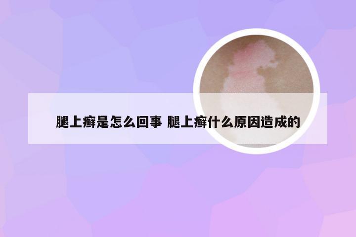 腿上癣是怎么回事 腿上癣什么原因造成的