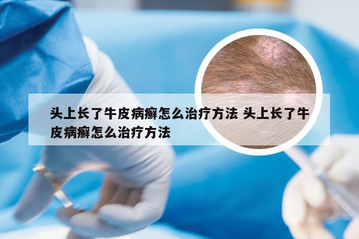 头上长了牛皮病癣怎么治疗方法 头上长了牛皮病癣怎么治疗方法