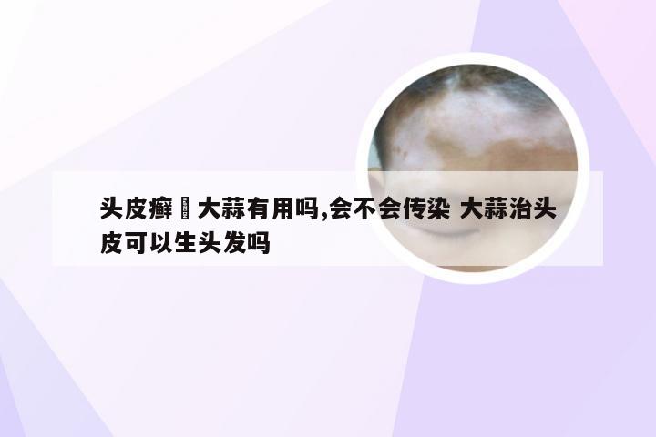 头皮癣抺大蒜有用吗,会不会传染 大蒜治头皮可以生头发吗