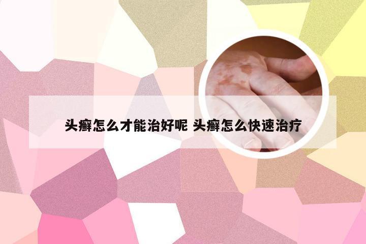 头癣怎么才能治好呢 头癣怎么快速治疗