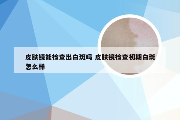 皮肤镜能检查出白斑吗 皮肤镜检查初期白斑怎么样