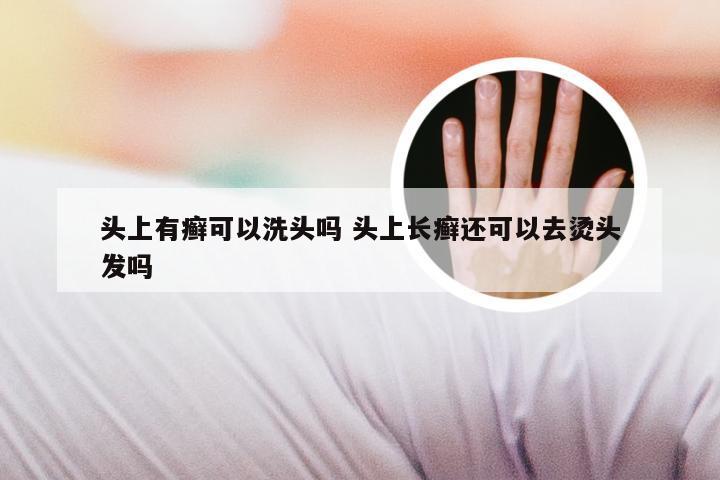 头上有癣可以洗头吗 头上长癣还可以去烫头发吗