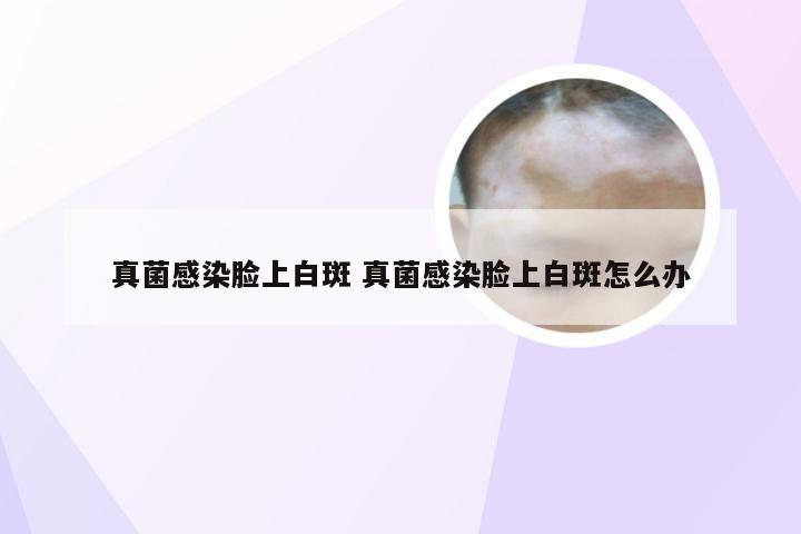 真菌感染脸上白斑 真菌感染脸上白斑怎么办