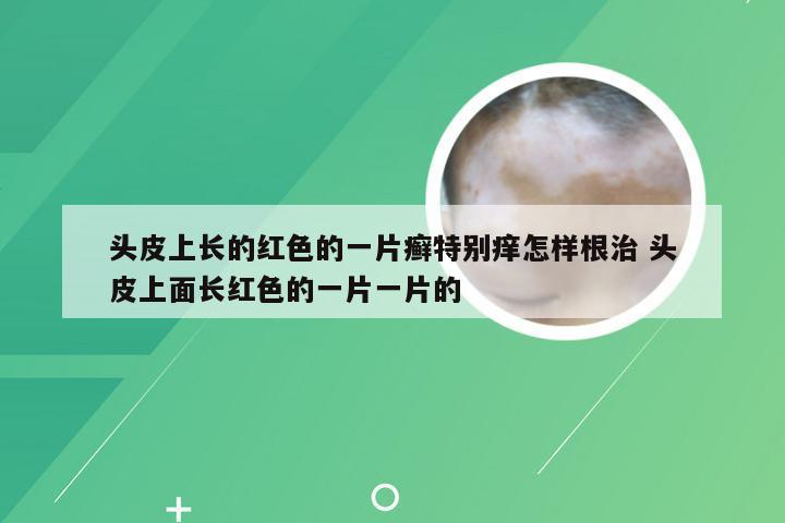 头皮上长的红色的一片癣特别痒怎样根治 头皮上面长红色的一片一片的