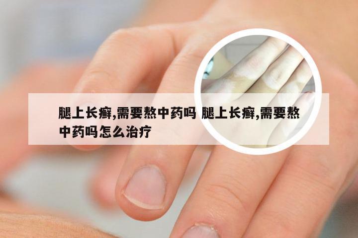 腿上长癣,需要熬中药吗 腿上长癣,需要熬中药吗怎么治疗